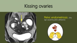 Kissing ovaries
Pelvic endometriosis (The
sign caused by pelvic adhesions)
 