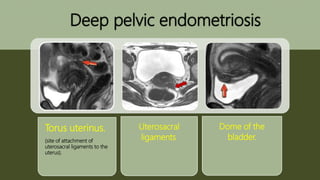 Deep pelvic endometriosis
Torus uterinus.
(site of attachment of
uterosacral ligaments to the
uterus).
Uterosacral
ligaments.
Dome of the
bladder.