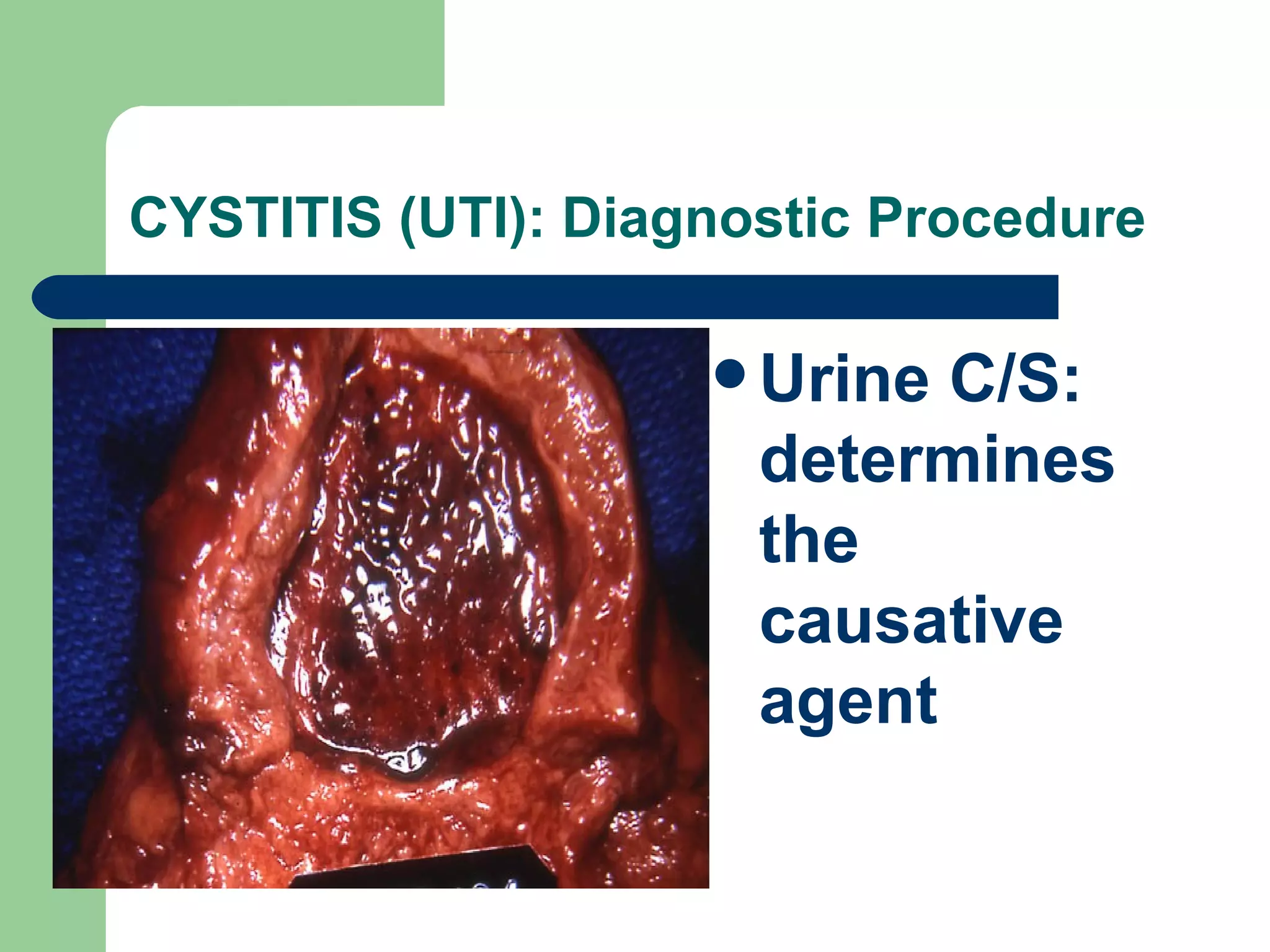 CYSTITIS (UTI): Diagnostic Procedure  Urine C/S: determines the causative agent 