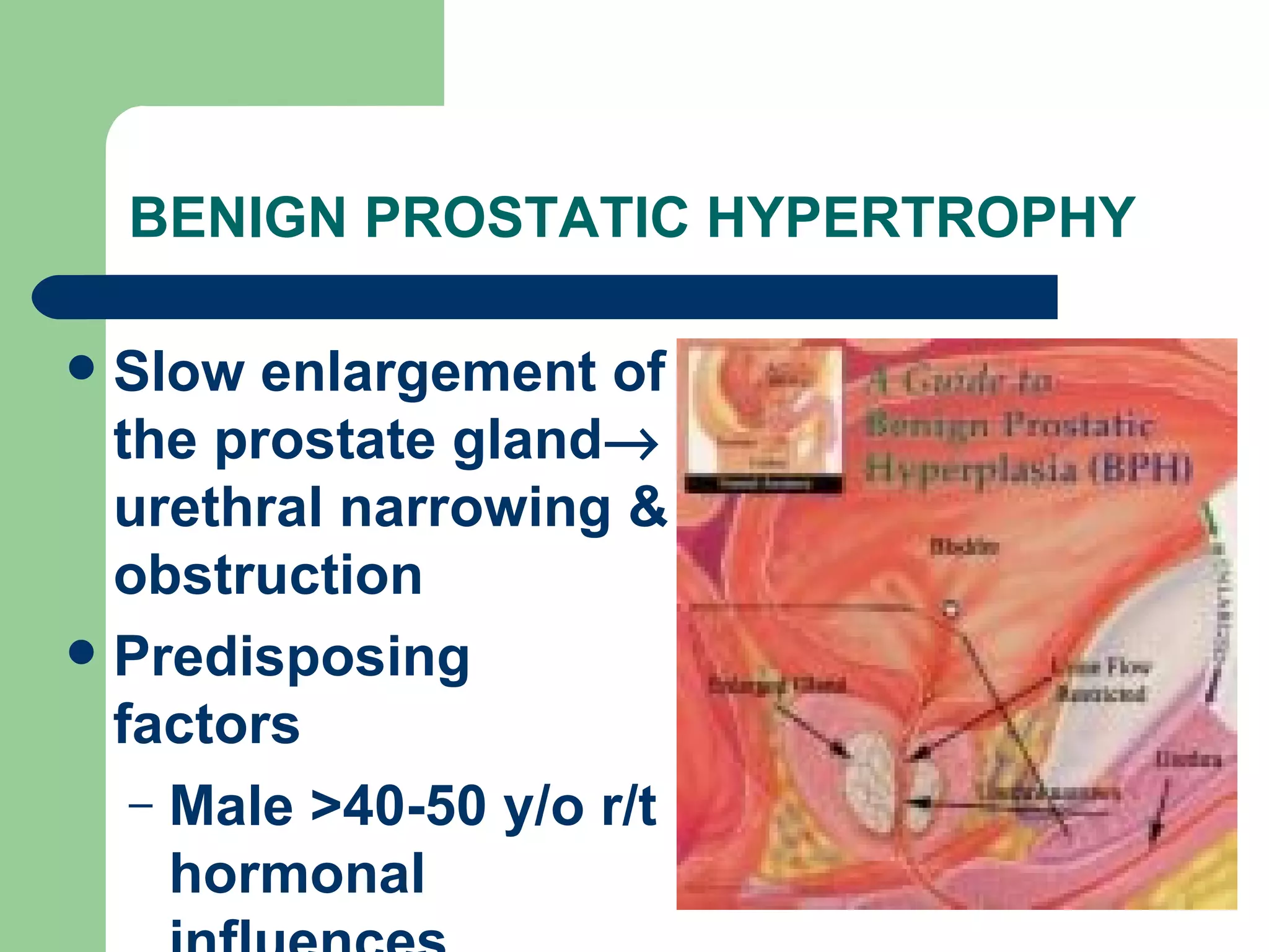 BENIGN PROSTATIC HYPERTROPHY Slow enlargement of the prostate gland   urethral narrowing & obstruction Predisposing factors Male >40-50 y/o r/t hormonal influences 