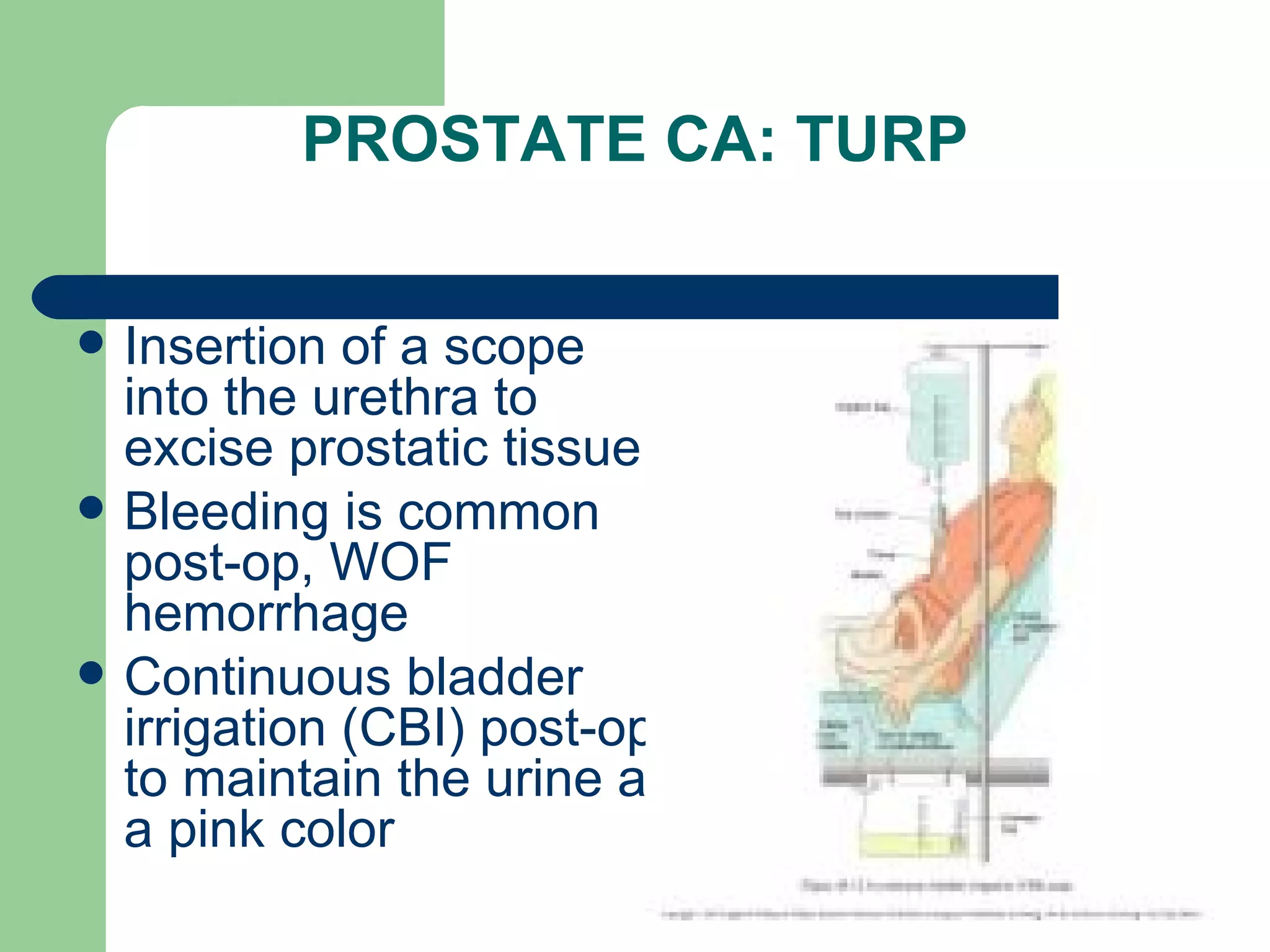 PROSTATE CA: TURP Insertion of a scope into the urethra to excise prostatic tissue Bleeding is common post-op, WOF hemorrhage Continuous bladder irrigation (CBI) post-op to maintain the urine at a pink color 