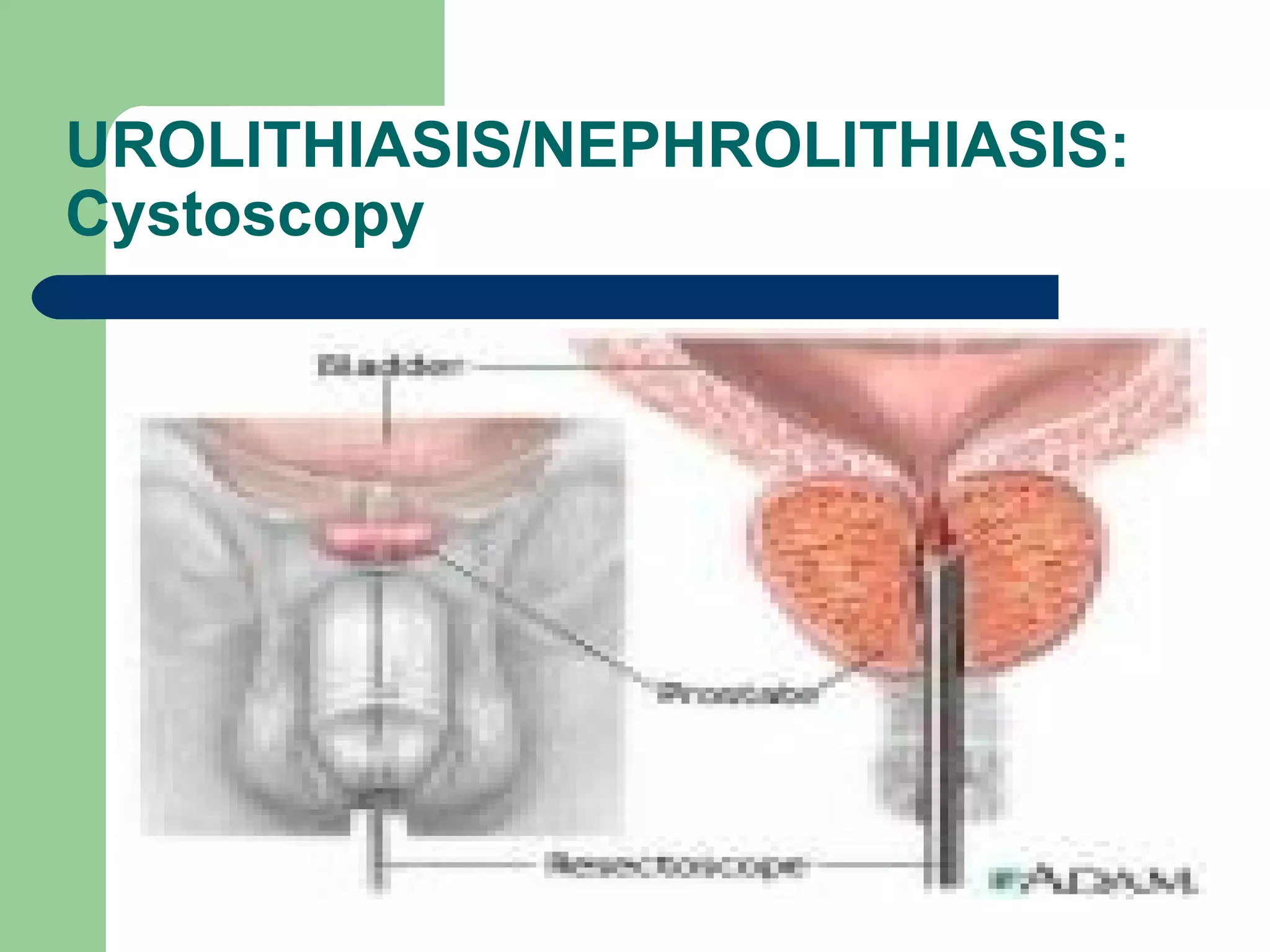 UROLITHIASIS/NEPHROLITHIASIS: Cystoscopy  