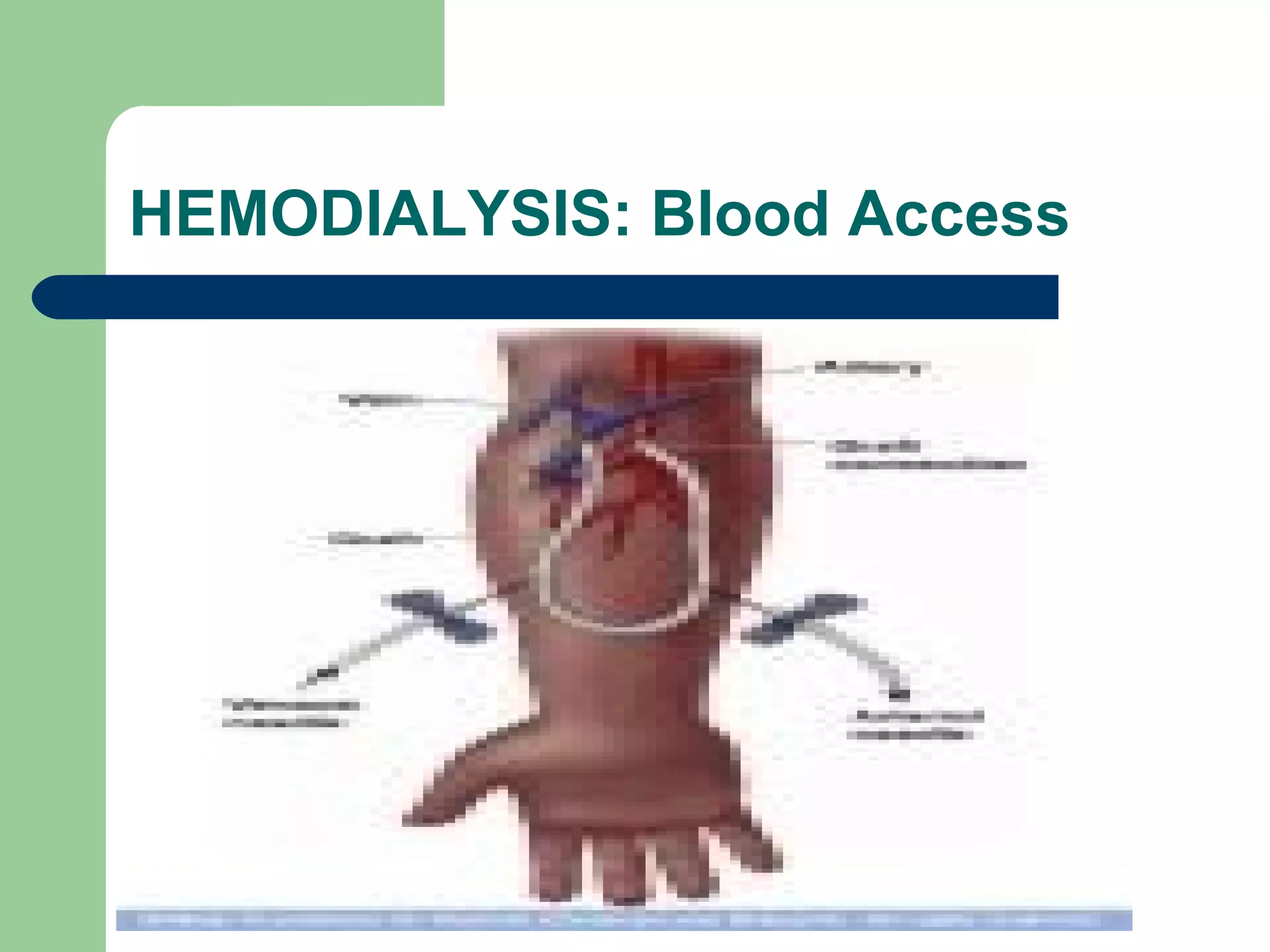 HEMODIALYSIS: Blood Access 