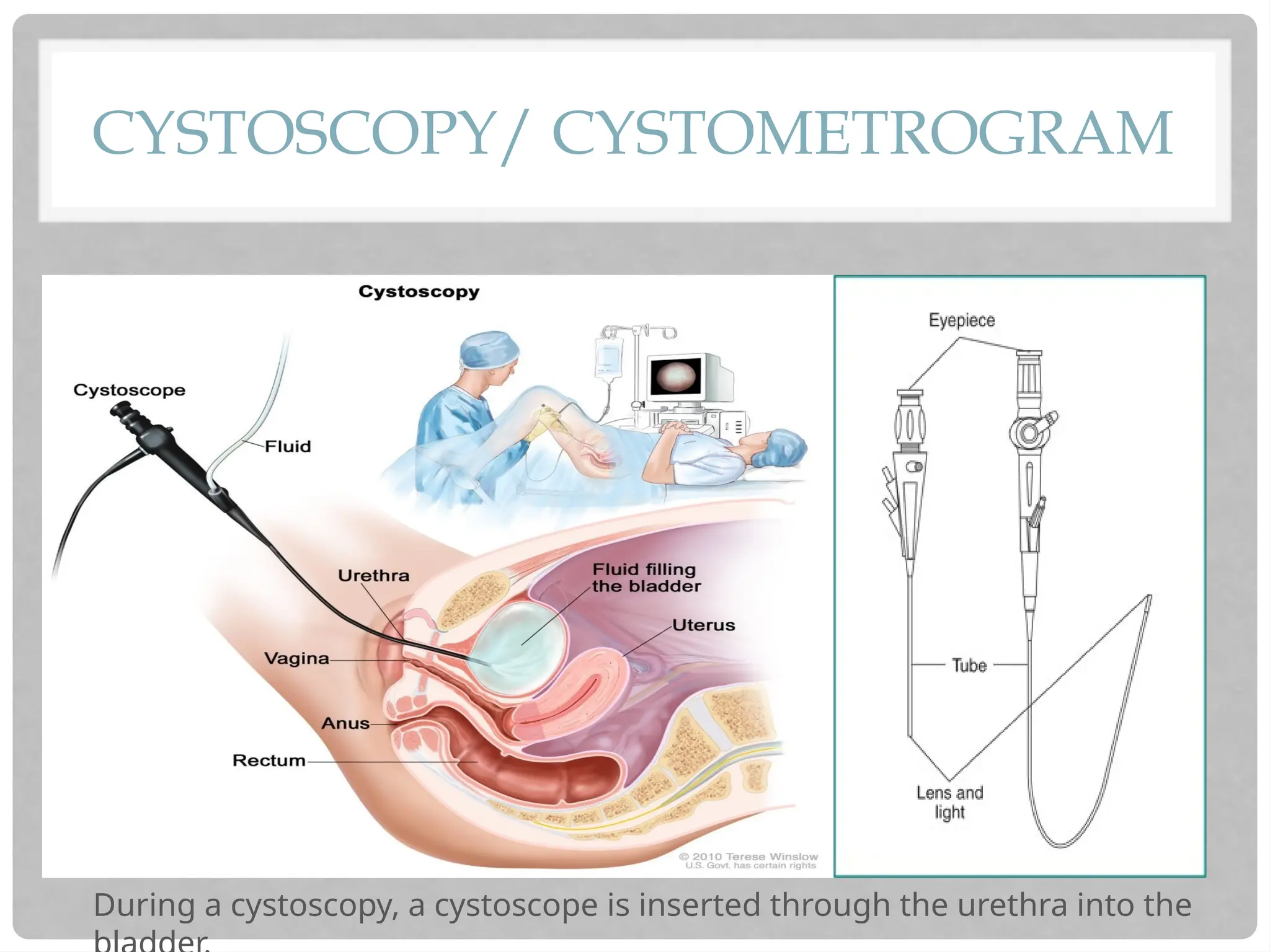 CYSTOSCOPY/ CYSTOMETROGRAM
During a cystoscopy, a cystoscope is inserted through the urethra into the
 