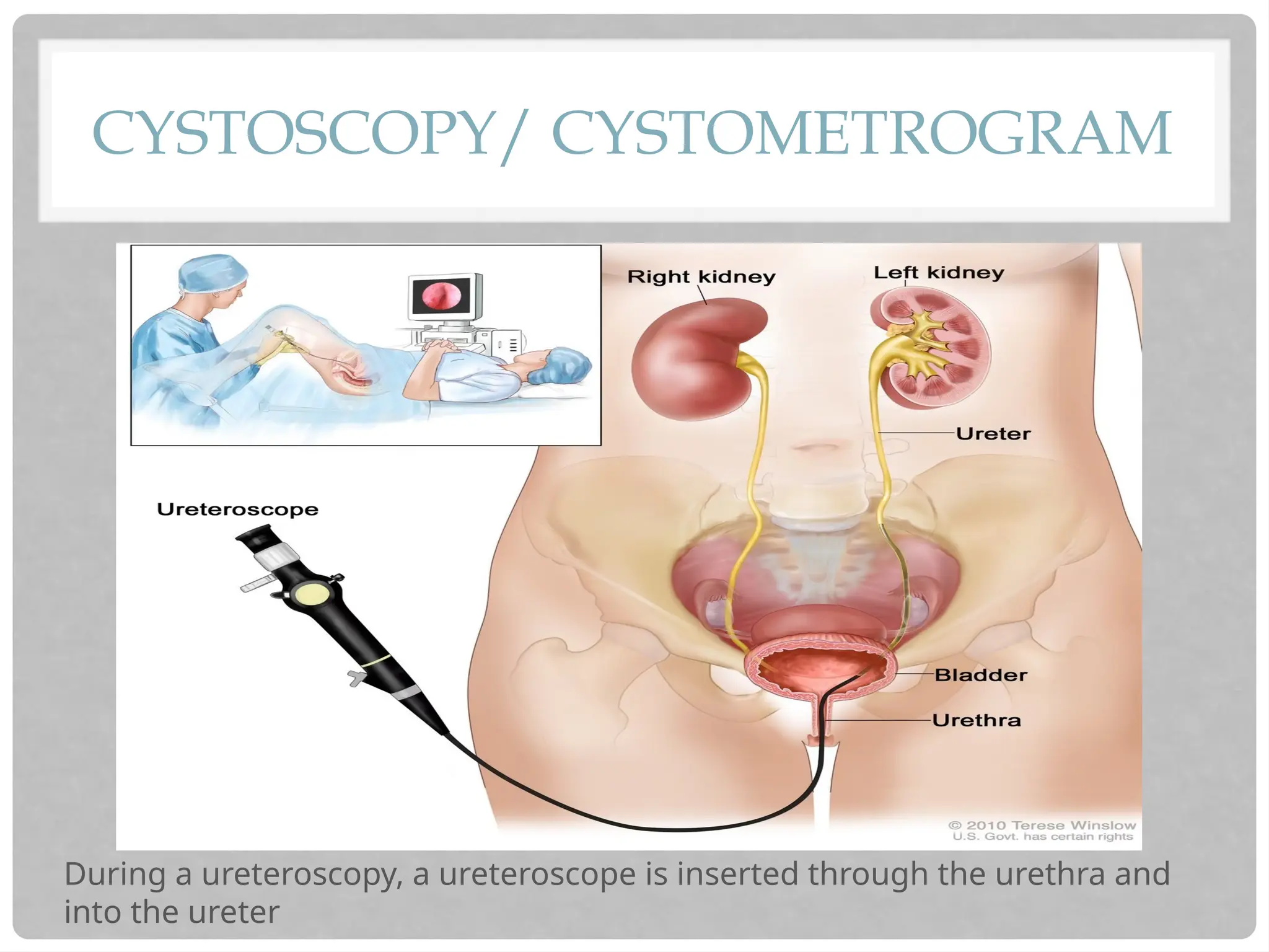 CYSTOSCOPY/ CYSTOMETROGRAM
During a ureteroscopy, a ureteroscope is inserted through the urethra and
into the ureter
 