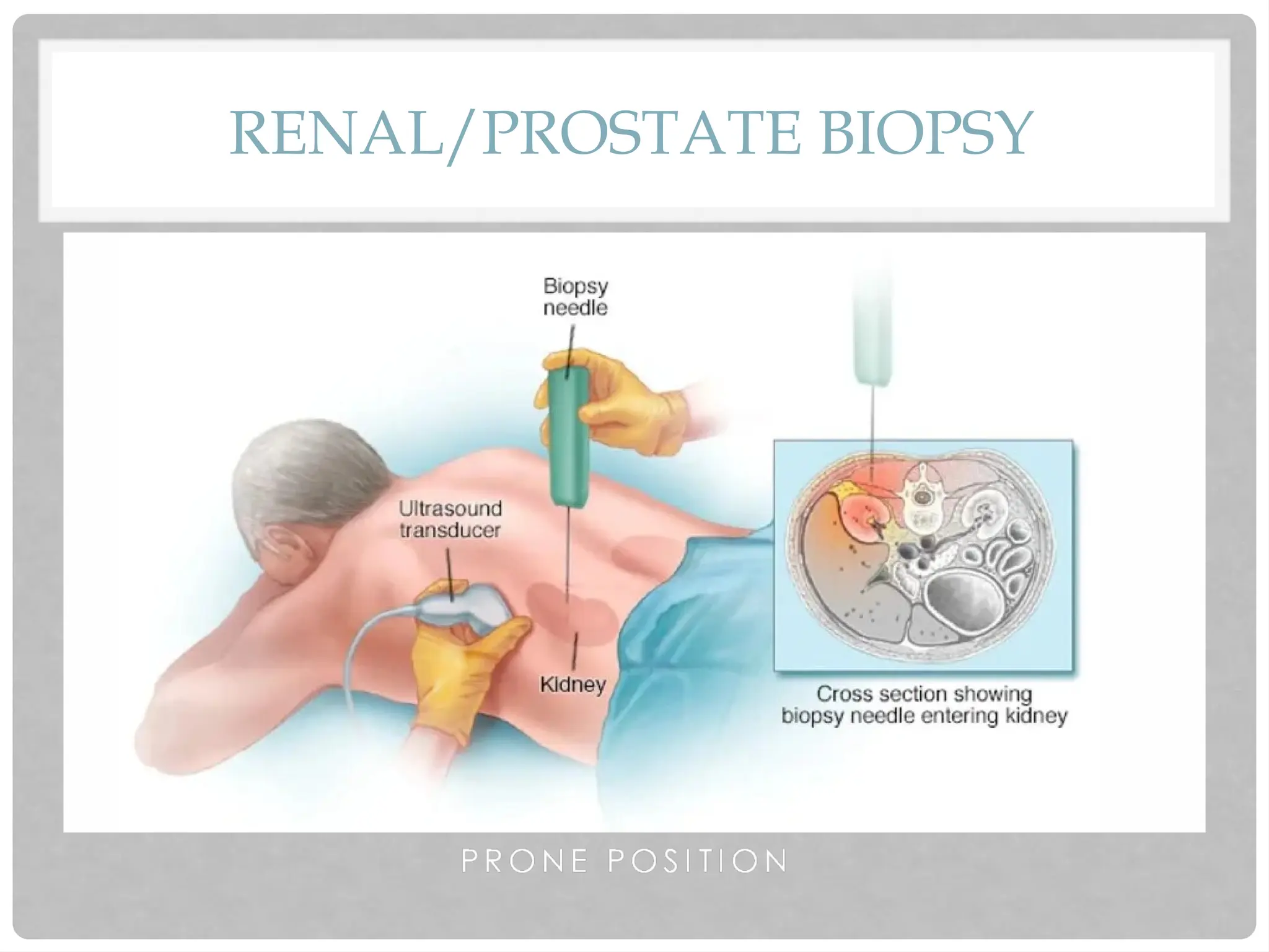 RENAL/PROSTATE BIOPSY
 