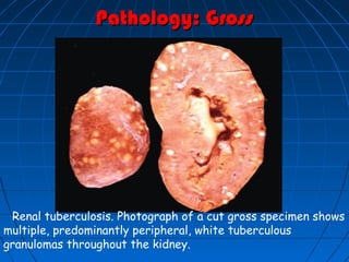 Pathology: GrossPathology: Gross
Renal tuberculosis. Photograph of a cut gross specimen shows
multiple, predominantly peripheral, white tuberculous
granulomas throughout the kidney.
 