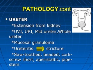 PATHOLOGYPATHOLOGY.cont.cont
 URETERURETER
*Extension from kidney*Extension from kidney
*UVJ, UPJ, Mid.ureter,Whole*UVJ, UPJ, Mid.ureter,Whole
ureterureter
*Mucosal granuloma*Mucosal granuloma
*Ureteritis stricture*Ureteritis stricture
*Saw-toothed, beaded, cork-*Saw-toothed, beaded, cork-
screw short, aperistaltic, pipe-screw short, aperistaltic, pipe-
stemstem
 