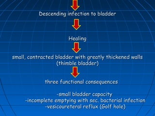 Descending infection to bladderDescending infection to bladder
HealingHealing
small, contracted bladder with greatly thickened wallssmall, contracted bladder with greatly thickened walls
(thimble bladder)(thimble bladder)
three functional consequencesthree functional consequences
-small bladder capacity-small bladder capacity
-incomplete emptying with sec. bacterial infection-incomplete emptying with sec. bacterial infection
-vesicoureteral reflux (Golf hole)-vesicoureteral reflux (Golf hole)
 