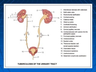 PATHOLOGYPATHOLOGY.cont.cont
EpididymisEpididymis
* Posterior sinus* Posterior sinus
* Scrotal swelling* Scrotal swelling
* Beaded vas* Beaded vas
 