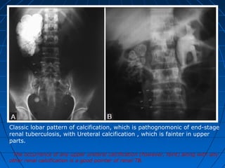 Classic lobar pattern of calcification, which is pathognomonic of end-stage
renal tuberculosis, with Ureteral calcification , which is fainter in upper
parts.
The occurrence of any upper ureteral calcification (however, faint) along with any
other renal calcification is a good pointer of renal TB.
 