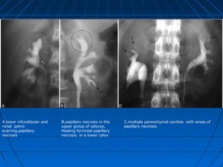 A.lower infundibular and
renal pelvic
scarring,papillary
necrosis
B.papillary necrosis in the
upper group of calyces,
Healing forniceal papillary
necrosis in a lower calyx
C.multiple parenchymal cavities with areas of
papillary necrosis
 