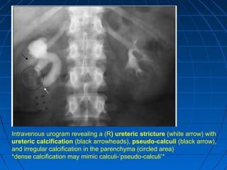 Intravenous urogram revealing a (R) ureteric stricture (white arrow) with
ureteric calcification (black arrowheads), pseudo-calculi (black arrow),
and irregular calcification in the parenchyma (circled area)
*dense calcification may mimic calculi ‘pseudo calculi’*‑ ‑
 