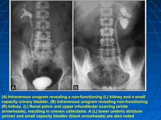 (A) Intravenous urogram revealing a non-functioning (L) kidney and a small
capacity urinary bladder. (B) Intravenous urogram revealing non-functioning
(R) kidney. (L) Renal pelvic and upper infundibular scarring (white
arrowheads), resulting in uneven caliectasis. A (L) lower ureteric stricture
(arrow) and small capacity bladder (black arrowheads) are also noted
 