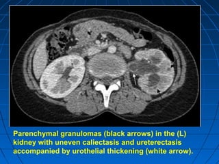 Parenchymal granulomas (black arrows) in the (L)
kidney with uneven caliectasis and ureterectasis
accompanied by urothelial thickening (white arrow).
 