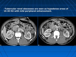oTubercular renal abscesses are seen as hypodense areas of
10 40 HU with mild peripheral enhancement.‑
 