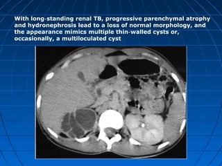 With long standing renal TB, progressive parenchymal atrophy‑
and hydronephrosis lead to a loss of normal morphology, and
the appearance mimics multiple thin walled cysts or,‑
occasionally, a multiloculated cyst
 