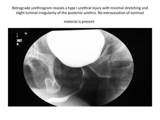 Trauma Urethrogram Genitourinary trauma | PPT