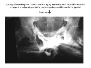 Trauma Urethrogram Genitourinary trauma | PPT