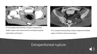 Extraperitonealrupture
 