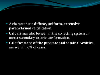  A characteristic diffuse, uniform, extensive
parenchymal calcification,
 Calculi may also be seen in the collecting system or
ureter secondary to stricture formation.
 Calcifications of the prostate and seminal vesicles
are seen in 10% of cases.
 