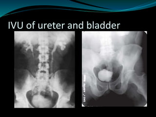 IVU of ureter and bladder
 