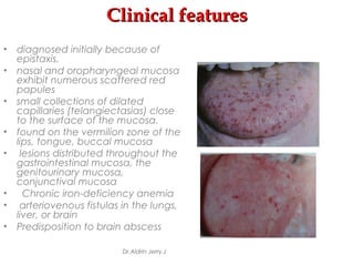 Clinical featuresClinical features
• diagnosed initially because of
epistaxis.
• nasal and oropharyngeal mucosa
exhibit numerous scattered red
papules
• small collections of dilated
capillaries (telangiectasias) close
to the surface of the mucosa.
• found on the vermilion zone of the
lips, tongue, buccal mucosa
• lesions distributed throughout the
gastrointestinal mucosa, the
genitourinary mucosa,
conjunctival mucosa
• Chronic iron-deficiency anemia
• arteriovenous fistulas in the lungs,
liver, or brain
• Predisposition to brain abscess
Dr.Aldrin Jerry.J
 