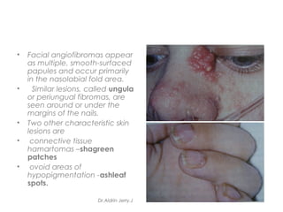 • Facial angiofibromas appear
as multiple, smooth-surfaced
papules and occur primarily
in the nasolabial fold area.
• Similar lesions, called ungula
or periungual fibromas, are
seen around or under the
margins of the nails.
• Two other characteristic skin
lesions are
• connective tissue
hamartomas –shagreen
patches
• ovoid areas of
hypopigmentation -ashleaf
spots.
Dr.Aldrin Jerry.J
 