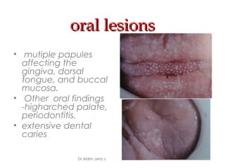 oral lesionsoral lesions
• mutiple papules
affecting the
gingiva, dorsal
tongue, and buccal
mucosa.
• Other oral findings
-higharched palate,
periodontitis,
• extensive dental
caries
Dr.Aldrin Jerry.J
 