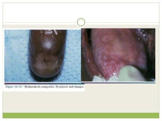 Genodermatosis Genodermatoses | PPTX