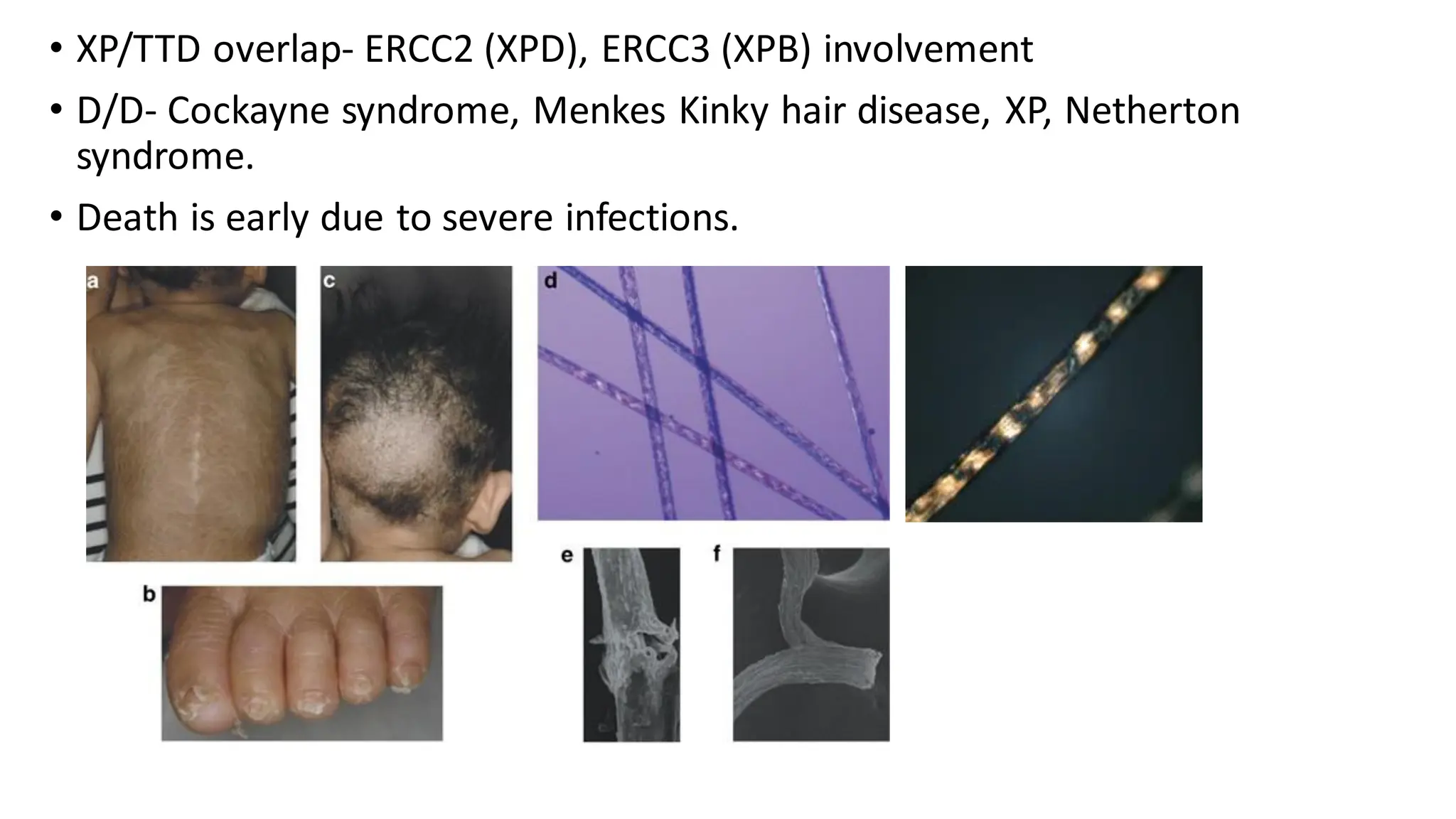 • XP/TTD overlap- ERCC2 (XPD), ERCC3 (XPB) involvement
• D/D- Cockayne syndrome, Menkes Kinky hair disease, XP, Netherton
syndrome.
• Death is early due to severe infections.
 