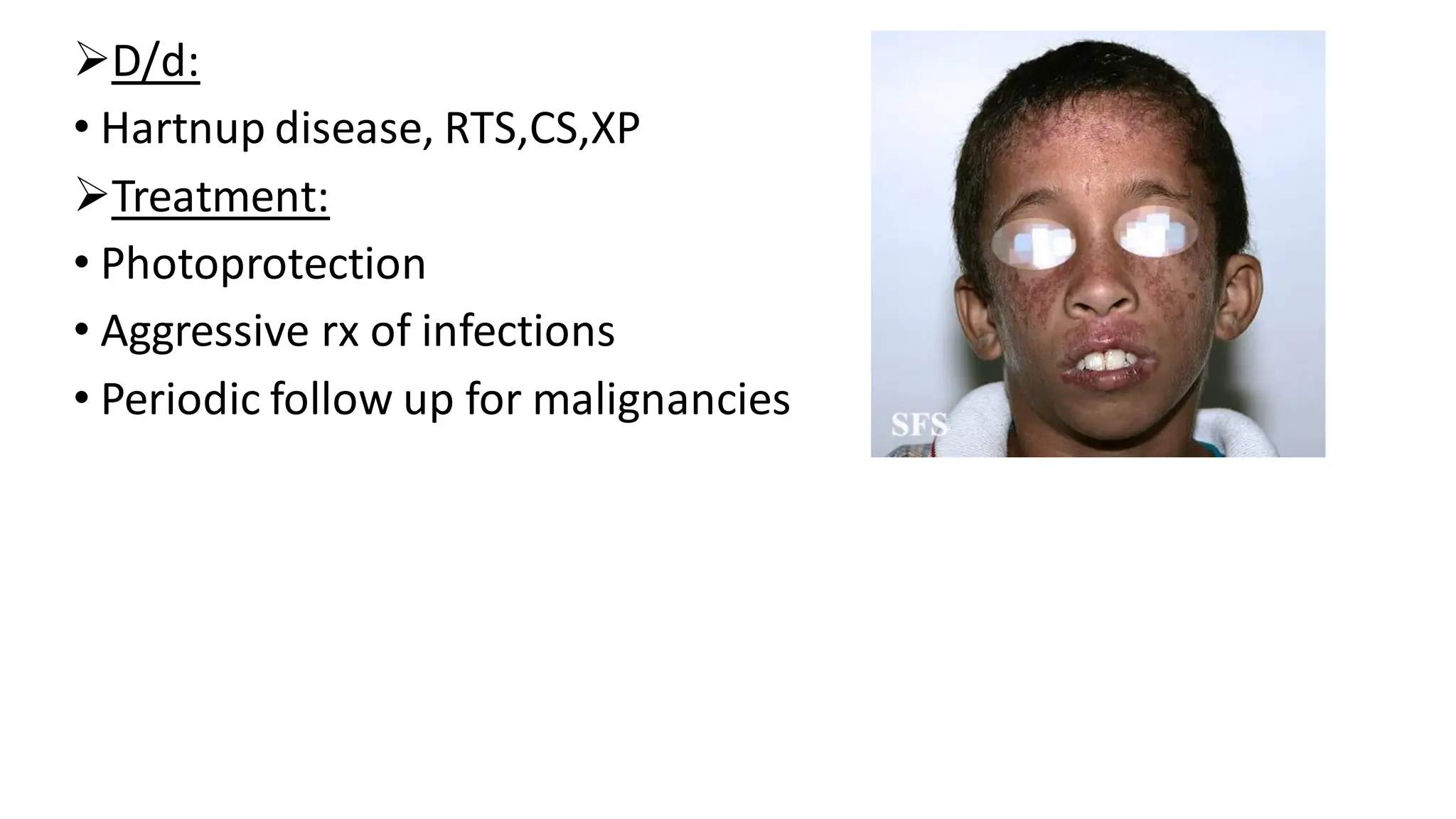 ➢D/d:
• Hartnup disease, RTS,CS,XP
➢Treatment:
• Photoprotection
• Aggressive rx of infections
• Periodic follow up for malignancies
 