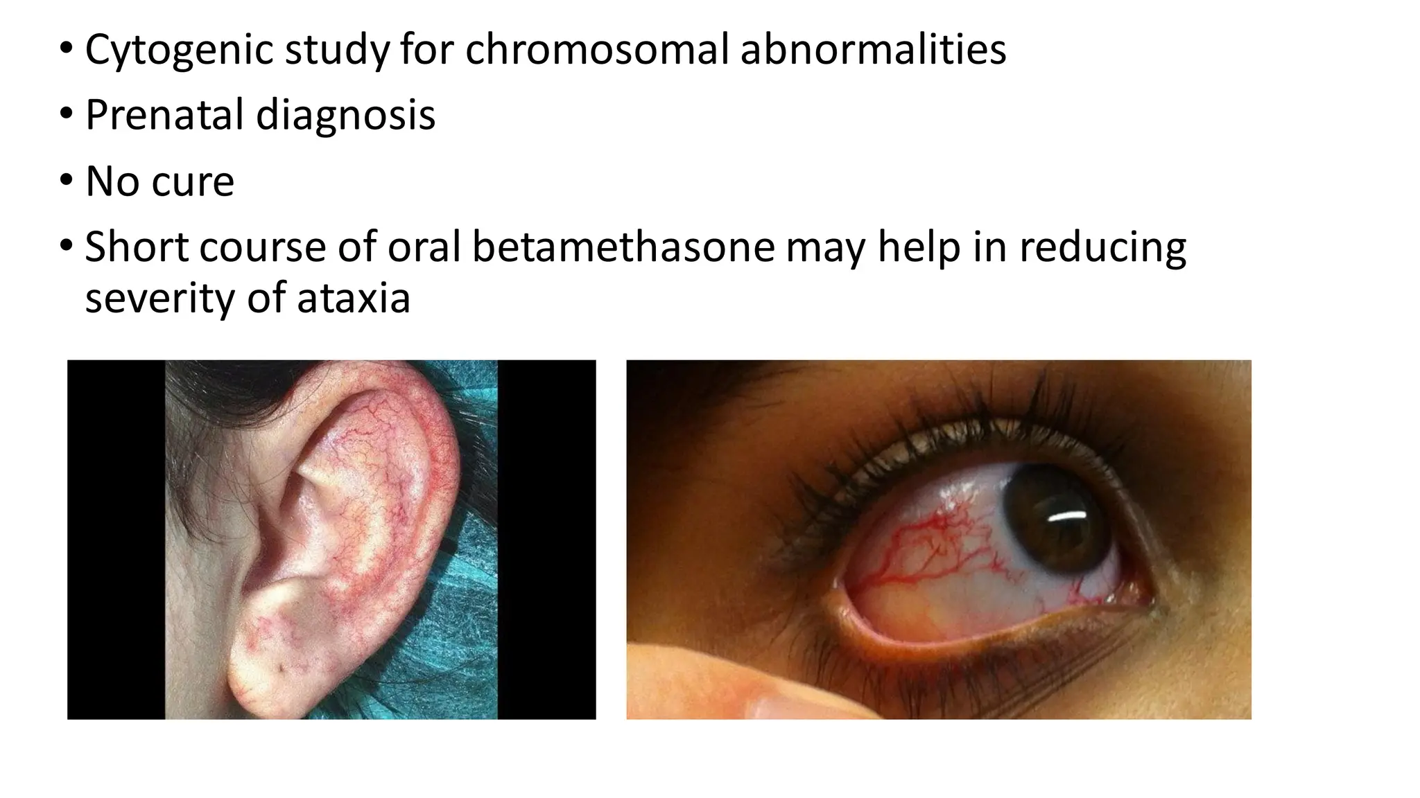 • Cytogenic study for chromosomal abnormalities
• Prenatal diagnosis
• No cure
• Short course of oral betamethasone may help in reducing
severity of ataxia
 