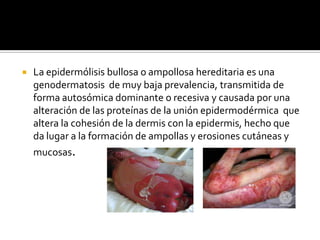    La epidermólisis bullosa o ampollosa hereditaria es una
    genodermatosis de muy baja prevalencia, transmitida de
    forma autosómica dominante o recesiva y causada por una
    alteración de las proteínas de la unión epidermodérmica que
    altera la cohesión de la dermis con la epidermis, hecho que
    da lugar a la formación de ampollas y erosiones cutáneas y
    mucosas.
 