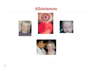 Albinismos
 