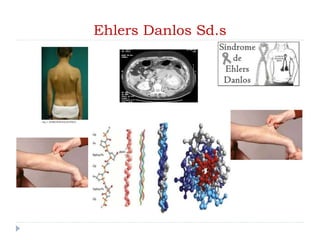 Ehlers Danlos Sd.s
 