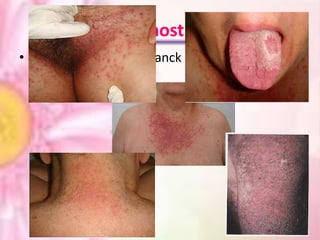 Diagnostico
• Citodiagnóstico de tzanck

 