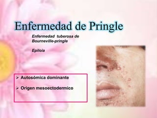 Enfermedad de Pringle
Enfermedad tuberosa de
Bourneville-pringle
Epiloia

 Autosómica dominante
 Origen mesoectodermico

 