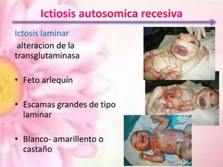 Ictiosis autosomica recesiva
Ictosis laminar
alteracion de la
transglutaminasa
• Feto arlequín
• Escamas grandes de tipo
laminar
• Blanco- amarillento o
castaño

 