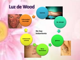 Luz de Wood
Lipomas

Enfermedad
de pringle

Sd. albright

No hay
tratamiento
Cisticercosis
cutanea

glomus

Nevo
lipomatoso

 