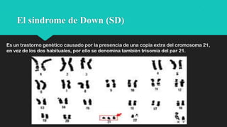 El síndrome de Down (SD)
Es un trastorno genético causado por la presencia de una copia extra del cromosoma 21,
en vez de los dos habituales, por ello se denomina también trisomía del par 21.

 