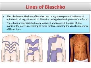 • Blaschko lines or the lines of Blaschko are thought to represent pathways of
epidermal cell migration and proliferation during the development of the fetus.
• These lines are invisible but many inherited and acquired diseases of skin
manifest themselves according to these patterns creating the visual appearance
of these lines.
 