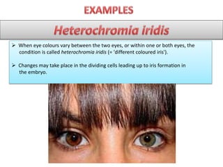  When eye colours vary between the two eyes, or within one or both eyes, the
condition is called heterochromia iridis (= 'different coloured iris').
 Changes may take place in the dividing cells leading up to iris formation in
the embryo.
 