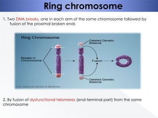 Ring chromosome
1. Two DNA breaks, one in each arm of the same chromosome followed by
fusion of the proximal broken ends

2. By fusion of dysfunctional telomeres (end-terminal part) from the same
chromosome

 