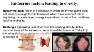 Hypothyroidism, which is a condition in which the thyroid gland does
not produce enough thyroid hormones which have important role in
regulating metabolism and energy expenditure, is one of the conditions
leading to obesity.
Cushing’s syndrome is another condition causing obesity, in this
disorder there will be excessive production of the hormone Cortisol by
the adrenal gland or exogenous cortisol is taken as medication leading
to change in the fat metabolism.
Endocrine factors leading to obesity:
18
 