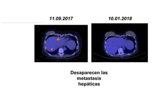 10.01.2018
11.09.2017
Desaparecen las
metastasis
hepáticas
 