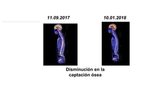 10.01.2018
11.09.2017
Disminución en la
captación ósea
 
