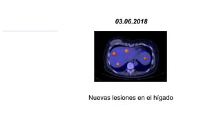 03.06.2018
Nuevas lesiones en el hígado
 