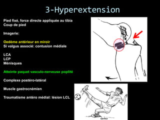 LESIONS_genou-traumatique-ligaments3.pdf