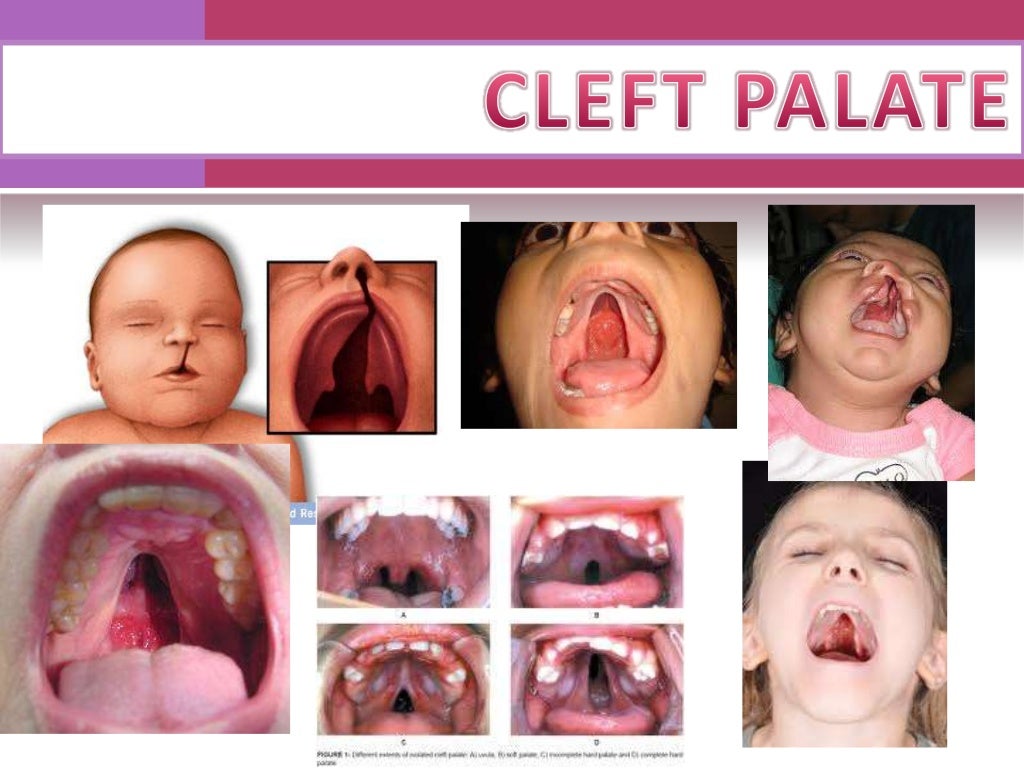 Cleft Palate